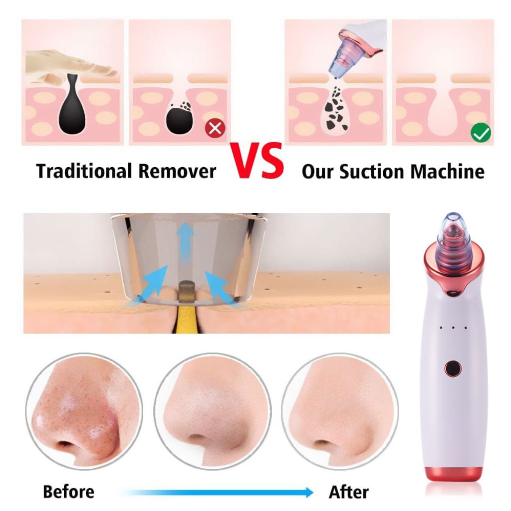 Electric Acne Remover Blackhead Apparatus - Bath &amp; Beauty